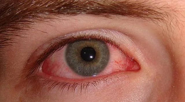 Redness